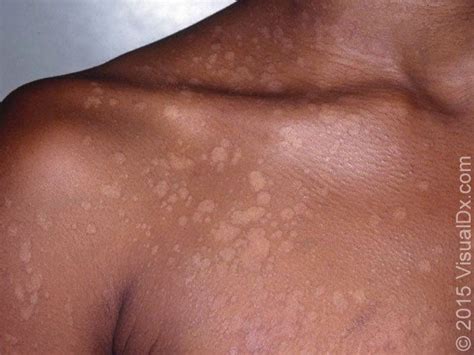 Tinea Versicolor Ie Pityriasis Versicolor Is A Common Superficial