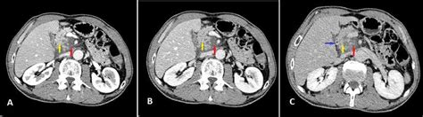 Axial Abdominal Computed Tomography Ctarterial Phase A Portal