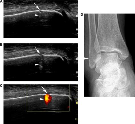 Color Doppler Sonography Accompanied By Dynamic Scanning For The