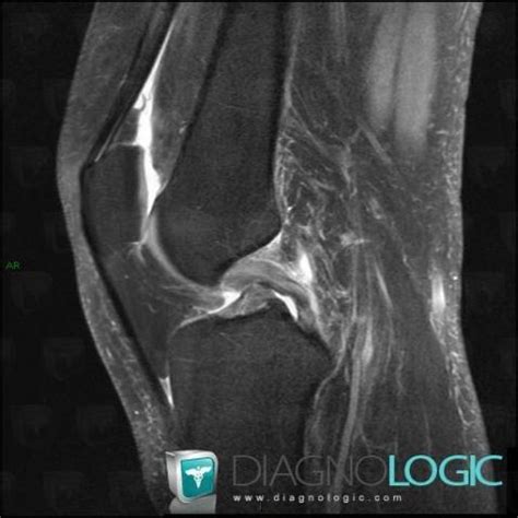 Radiology Case Meniscal Ossicle Mri X Rays Diagnologic