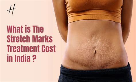 The Ultimate Guide To Getting Rid Of Stretch Marks Flauntchic