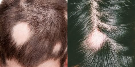 How To Stop Alopecia Areata From Spreading Hair System