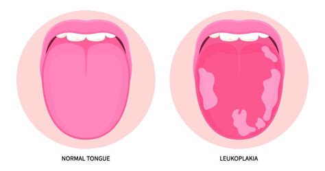 What Is Leukoplakia Symptoms Risks And Treatment Options