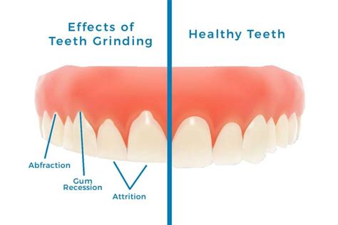 Dr Rachel Ho Bruxism Causes Symptoms And Treatments For Teeth Grinding