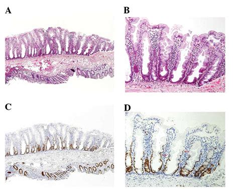 Sessile Serrated Adenoma Vs Hyperplastic Polyp