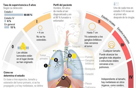 No Fumar Sigue Siendo Lo Más Efectivo Contra El Cáncer De Pulmón