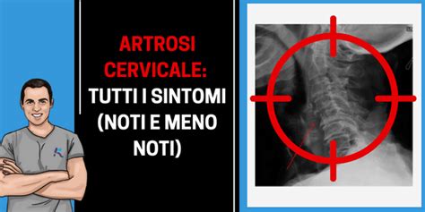 Artrosi Cervicale Sintomi Quali Sono E Come Risolverli