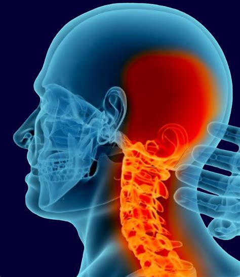 Occipital Neuralgia Images