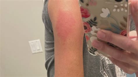 COVID Arm Vaccine Side Effect Is Swollen Red Arm Around Shot Cbs8