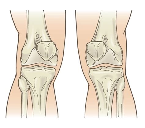 Examination Of The Knee Flashcards Quizlet