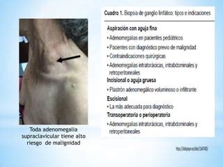 Sindrome Vena Cava Superior Ppt