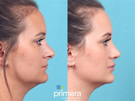 Revision Rhinoplasty Before And After Pictures Case 820 Orlando