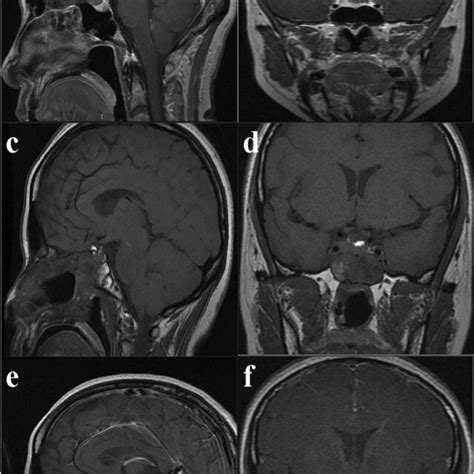 A 26 Year Old Woman With Suprasellar Rcc The Enhanced Sagittal A And