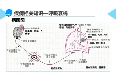 PPT慢性阻塞性肺疾病合并呼吸衰竭疑难病例讨论 巴巴