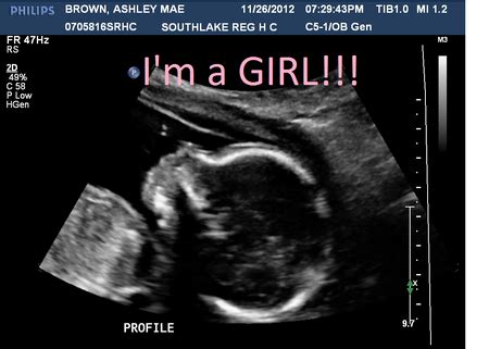 Skull Shape Determines Sex BabyCenter