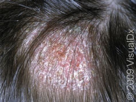 Scalp Infections Types And Ayurvedic Ways To Treat Them Off