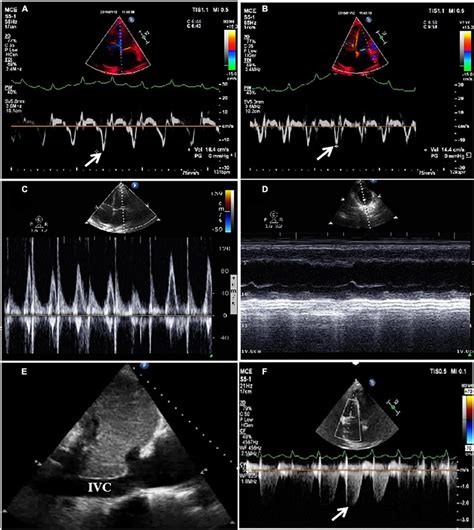 Tissue Doppler Imaging Tdi Using Echocardiography Revealed That E