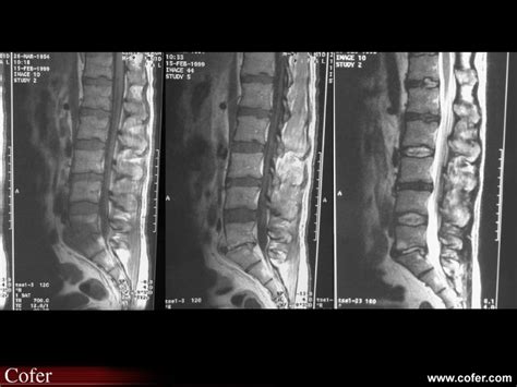 Spondylodiscite infectieuse Diapothèque du COFER