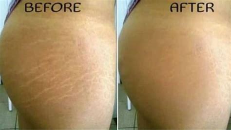 2oz 100 Natural Stretch Marks And Cellulite Removal Cream Etsy