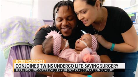 Conjoined Twins Successfully Separated By Texas Doctors After 11 Hour Surgery