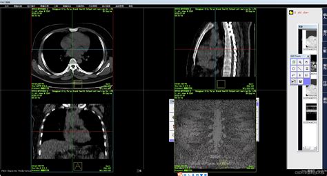 医学影像pacs系统源码 三维重建基本后处理方法的介绍和说明 Vtk 多平面重建 Mpr 及三维切片显示 Csdn博客