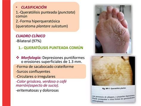 Molusco Contagioso Herpes Virus Y Queratolisis Plantar Dermatología