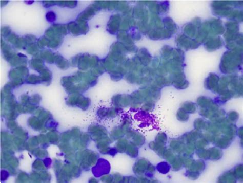 Bone Marrow Aspirate × 500 Toluidine Blue Staining Showing Compact