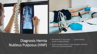 Hernia Nucleus Pulposus Hnp Pptx