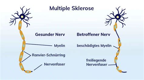 Multiple Sklerose Ms Symptome Verlauf Therapie