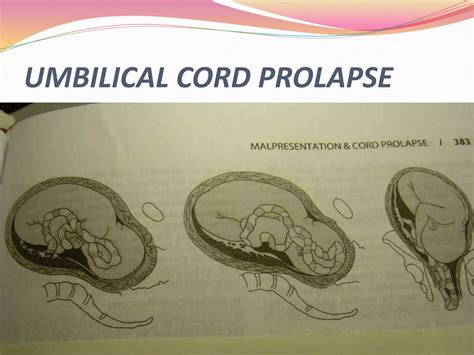 Umbilical Cord Prolapse Ppt