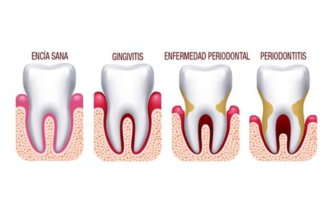 CONOCE LAS ENFERMEDADES PERIODONTALES Clinica Dental Unzeta