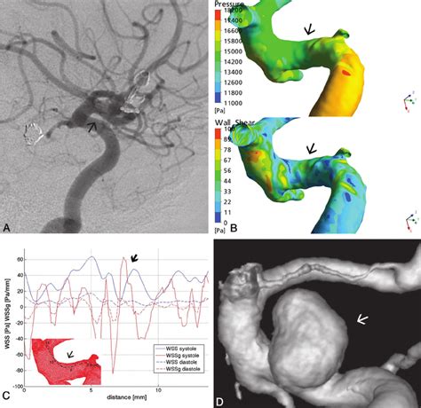 A Right ICA Lateral View DSA Of Patient 2 Shows No Aneurysm At The