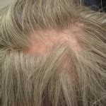 Scarring Alopecia Boston Krauss Dermatology