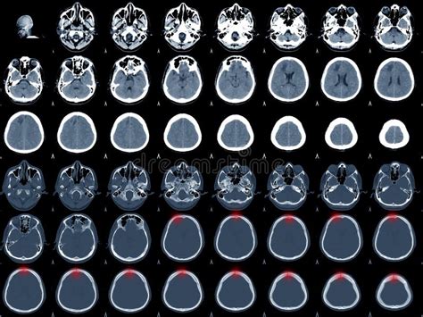 Ct Scan Brain Axial Scans With Mm Slice Thickness From Om Line To