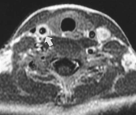 Takayasus Arteritis Assessment Of Disease Activity With Contrast