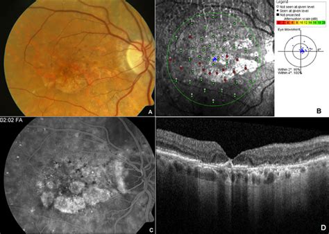 Scotoma | PLOS ONE