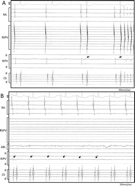 A Intracardiac Electrograms At The Initiation Of Atrial Fibrillation Download Scientific