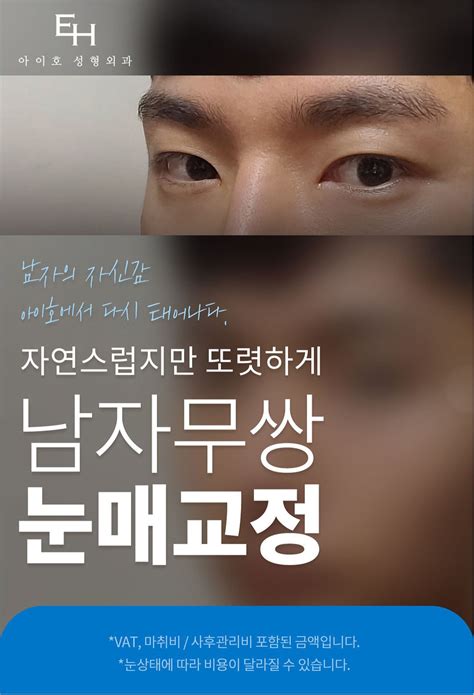 아이호 명품 남자 눈성형 By 아이호성형외과 강남언니 1등 성형수술and피부시술 정보앱