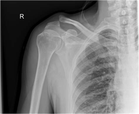 Concomitant Coracoid Base Fracture And Acromioclavicular Joint Disruption A Series Of Patients