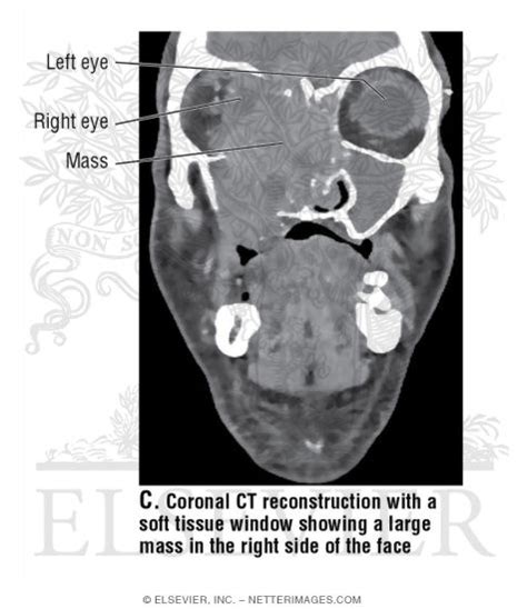 Coronal Ct Reconstruction With A Soft Tissue Window Showing A Large