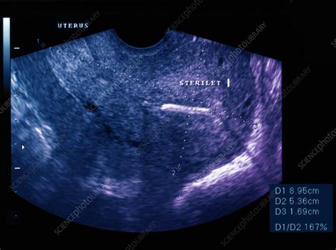 Normal Uterus With Iud Device Ultrasound Scan Stock Image C055