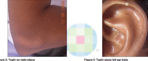 Figure 2 From Tophi As First Manifestation Of Gout Semantic Scholar