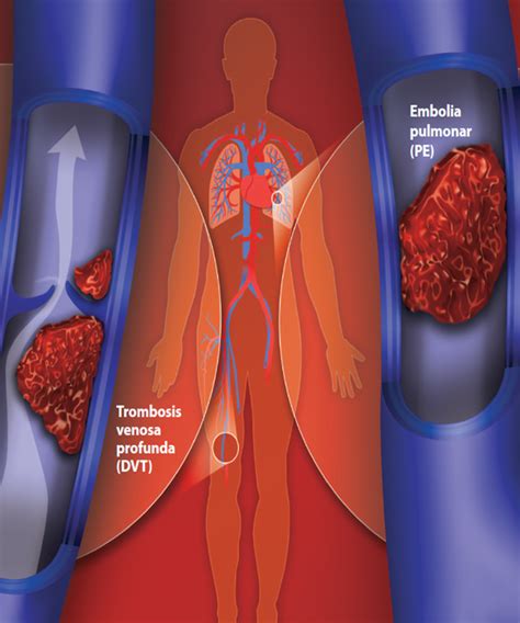 Trombosis Venosa Atenci N Vascular Tratamiento De V Rices Ulceras