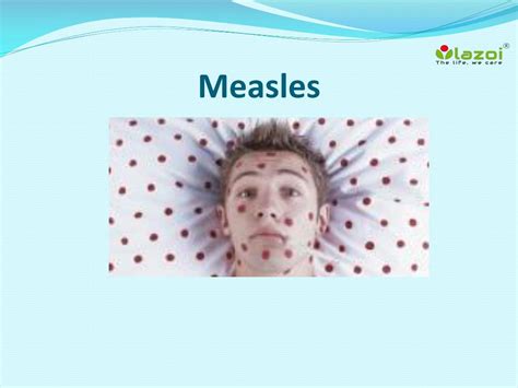 Ppt Measles Causes Symptoms Complications And Treatment Powerpoint Presentation Id 7633641