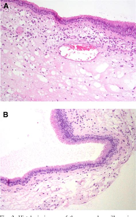 Figure From Root Resorption Caused By A Maxillary Sinus Mucocele A