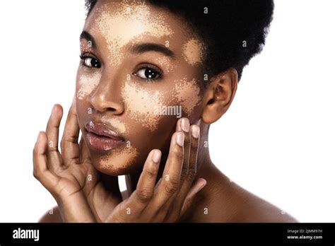 Beautiful Black Woman With Vitiligo Skin Disorder Stock Photo Alamy