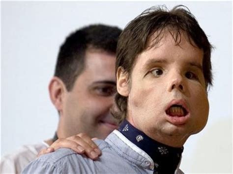 World’s First Full Face Transplant Performed » Popular Fidelity » Images