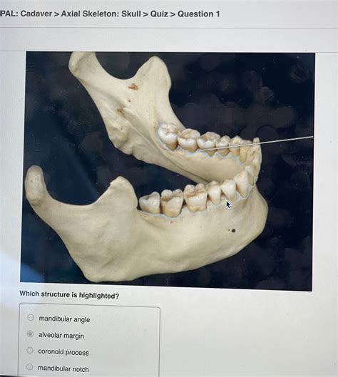 Solved Pal Cadaver Axial Skeleton Skull Quiz Question