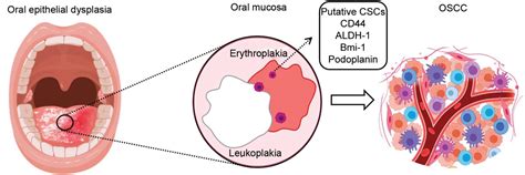 Erythroplakia Histopathology