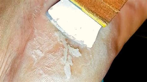 Foot Care Remove Dead Skin From Feet Youtube